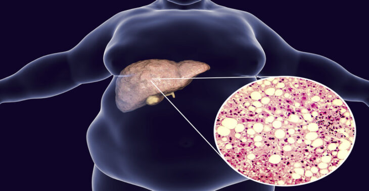 Lifestyle and Diet For Reducing a Fatty Liver